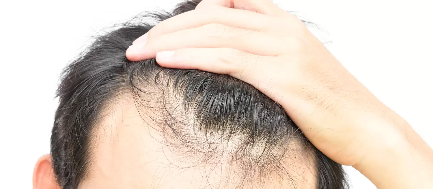 Saçlı Deri Kistleri