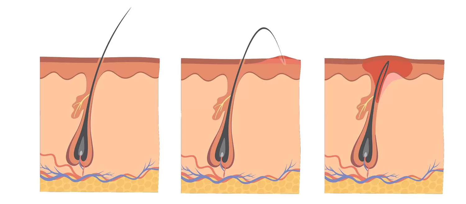 Pilonidal Sinüs (Kıl Dönmesi)