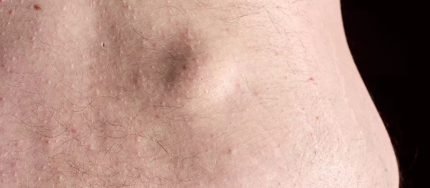 Lipomlar (Yağ Bezesi)